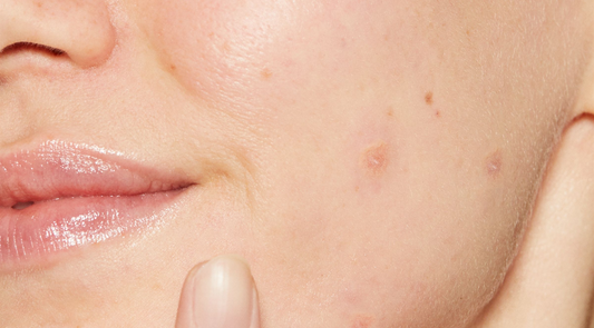 zap your teen’s breakouts fast