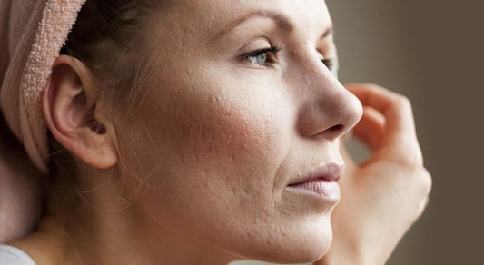 why are you breaking out? - Dermalogica Hong Kong