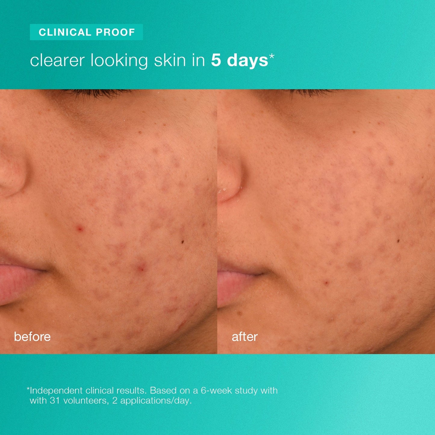 breakout biotic moisturizer