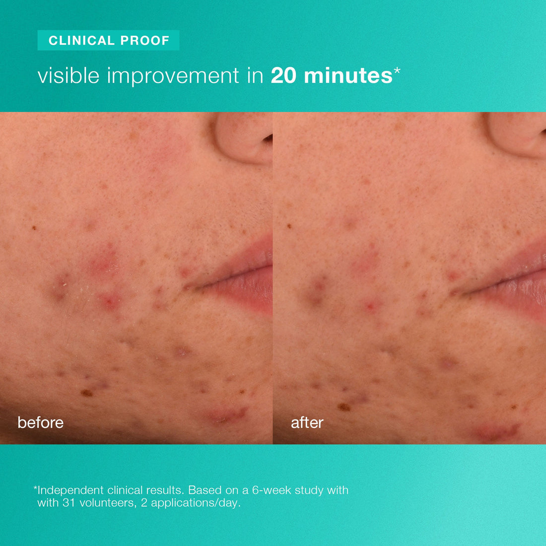 breakout biotic moisturizer