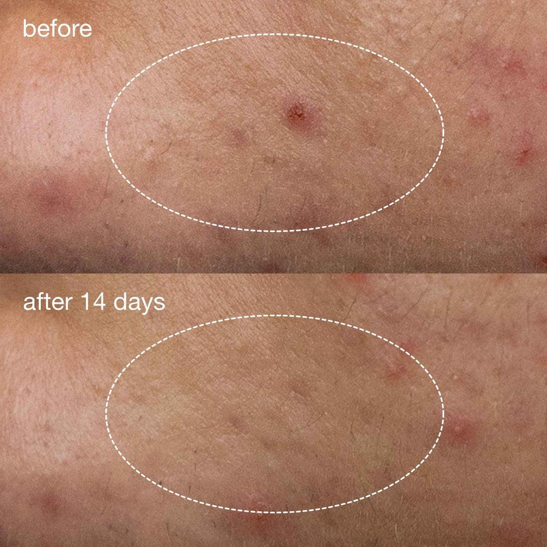 deep breakout liquid patch - Dermalogica Hong Kong